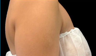 CoolSculpting Akron Before & After | Patient 02 Photo 1
