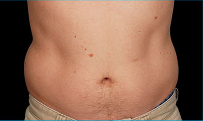 CoolSculpting Akron Before & After | Patient 05 Photo 0 Thumb