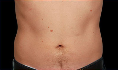 CoolSculpting Akron Before & After | Patient 05 Photo 1
