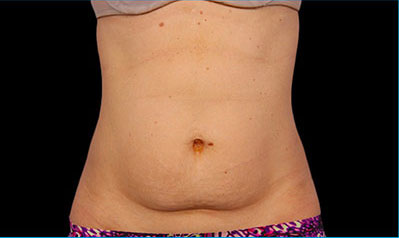 CoolSculpting Akron Before & After | Patient 06 Photo 0