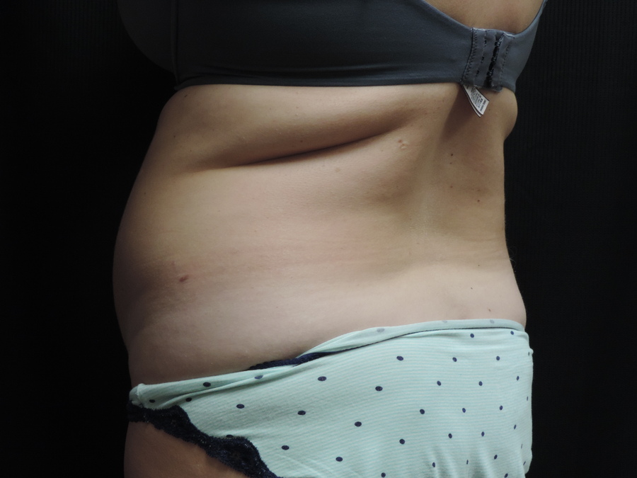 Liposuction Akron Before & After | Patient 01 Photo 4