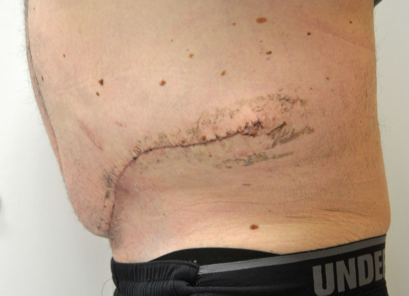 Panniculectomy Akron Before & After | Patient 01 Photo 3