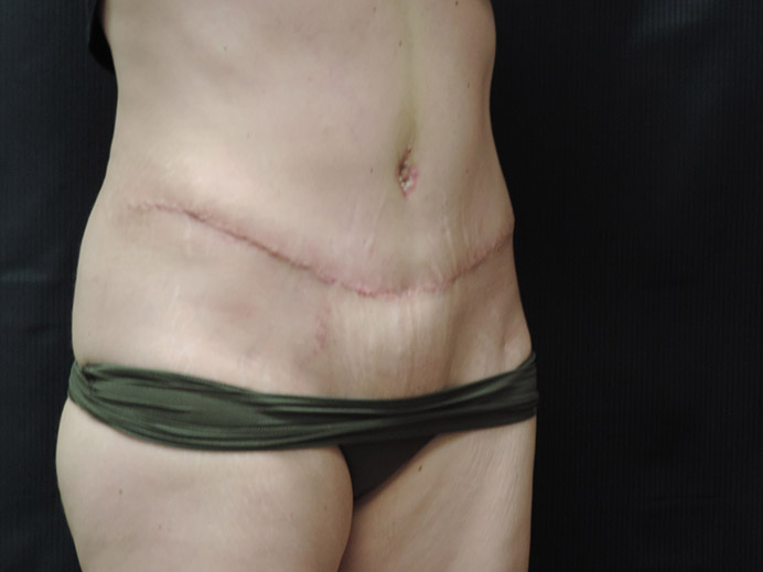 Tummy Tuck Akron Before & After | Patient 03 Photo 3 Thumb