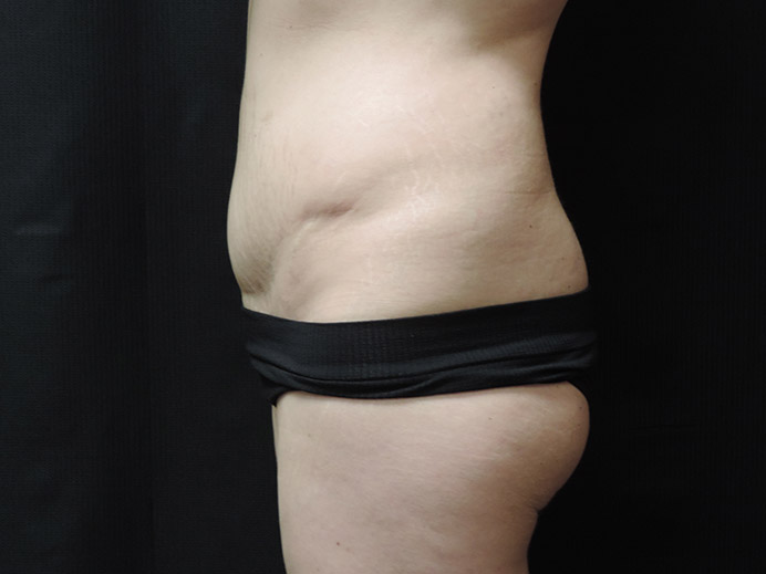 Tummy Tuck Akron Before & After | Patient 03 Photo 4