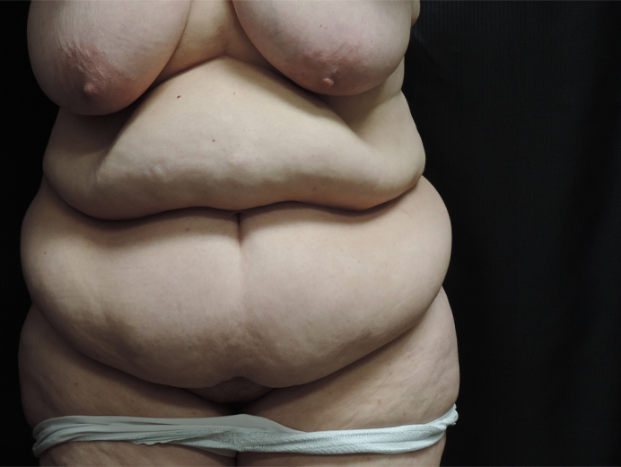 Tummy Tuck Akron Before & After | Patient 04 Photo 0