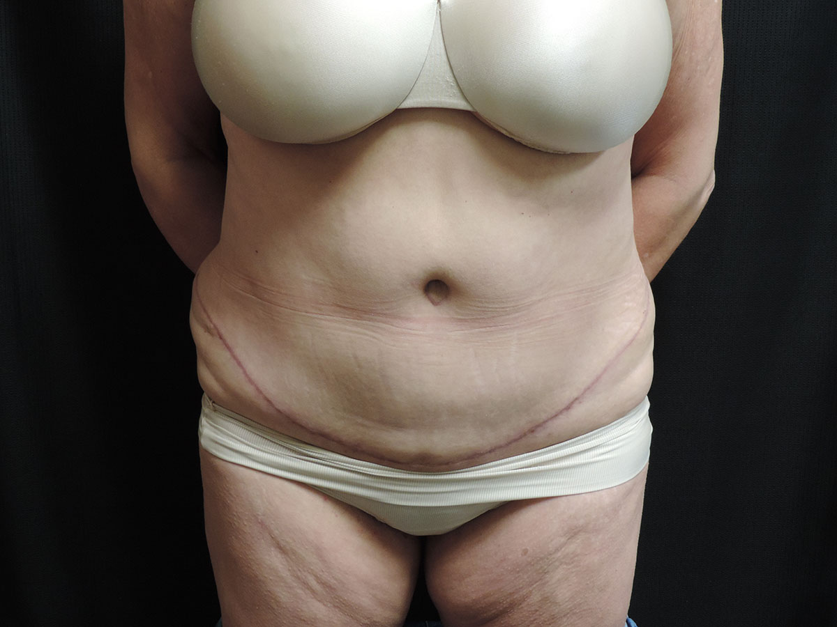 Tummy Tuck Akron Before & After | Patient 06 Photo 1
