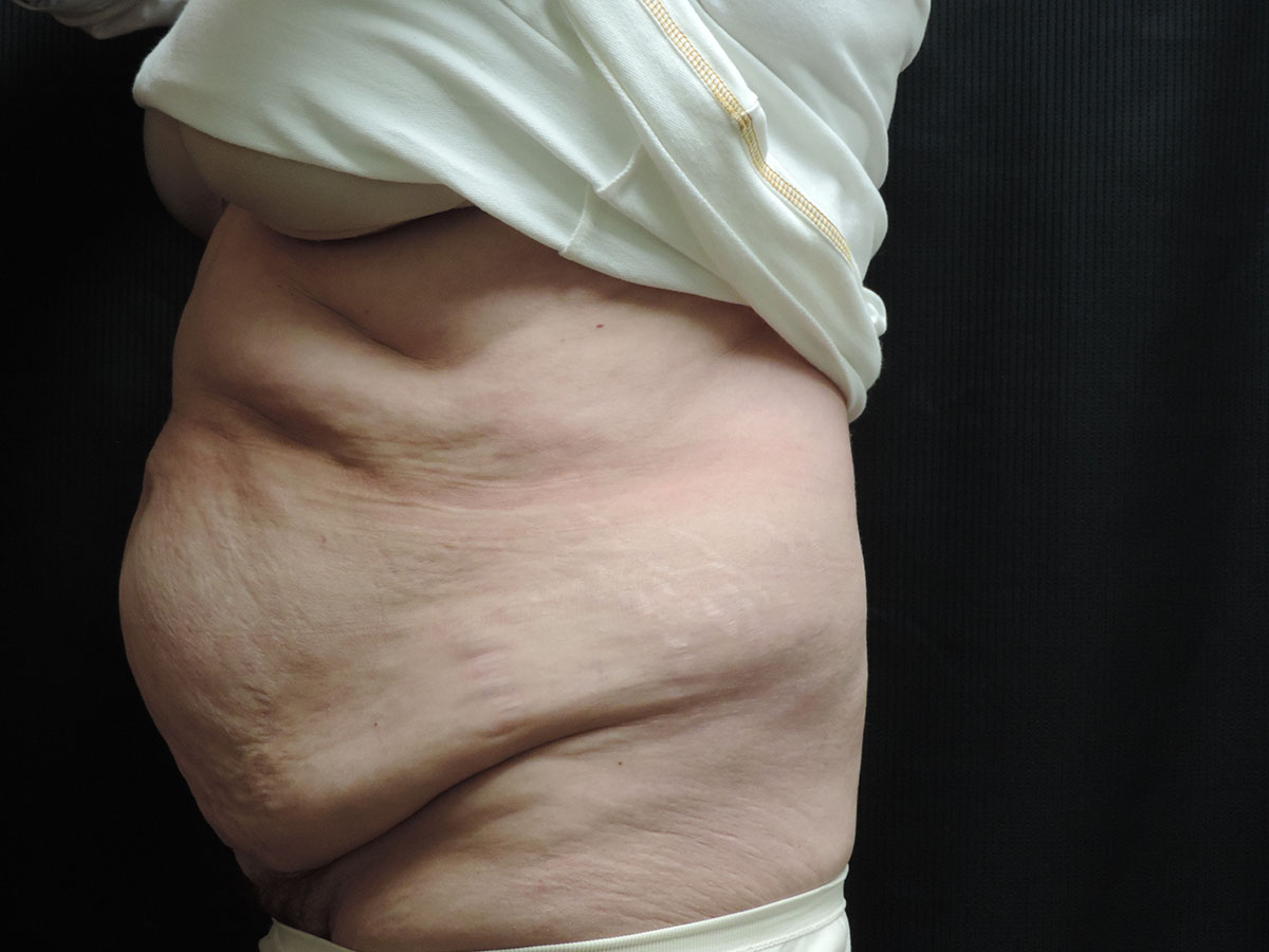 Tummy Tuck Akron Before & After | Patient 06 Photo 2