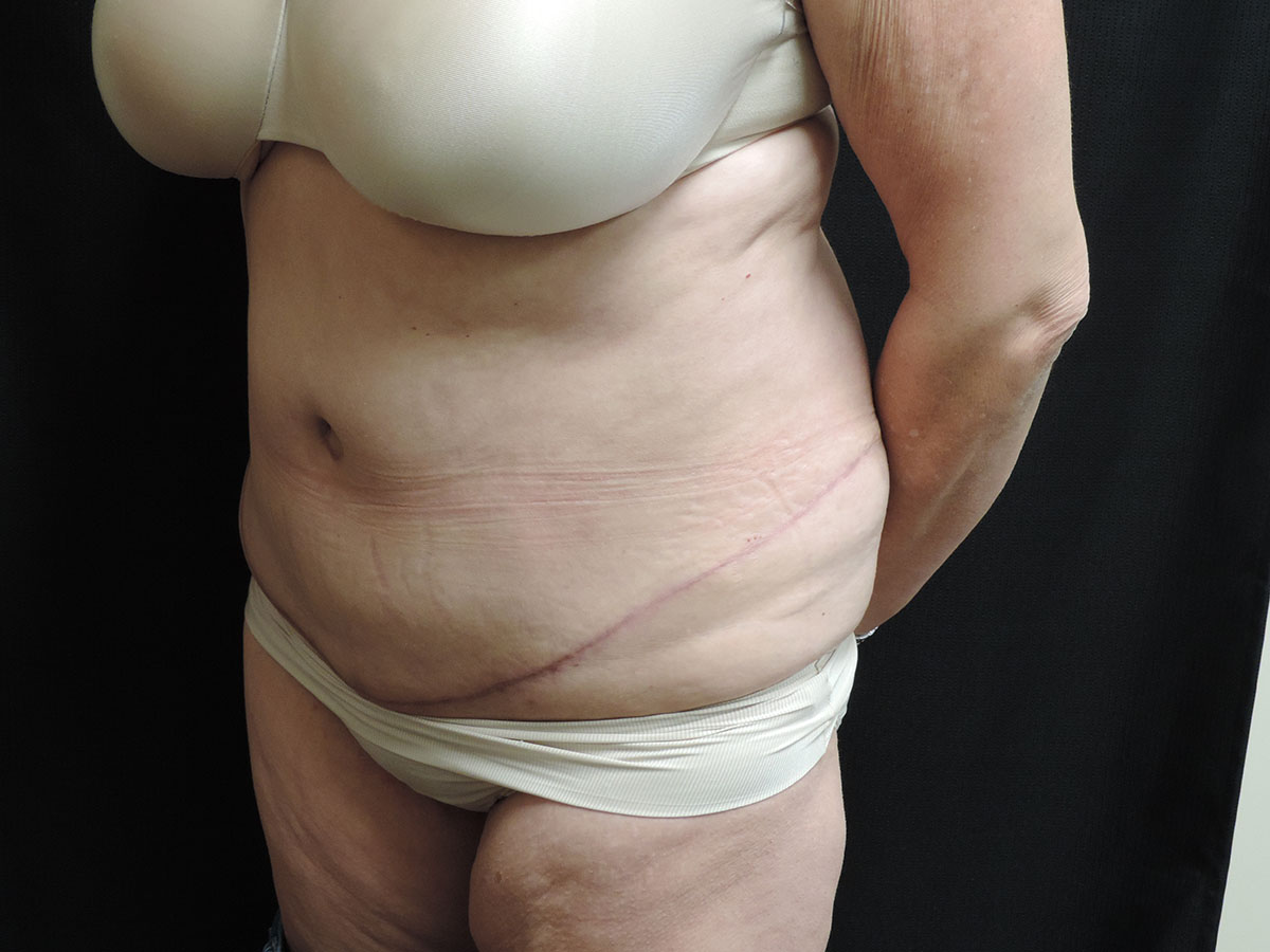 Tummy Tuck Akron Before & After | Patient 06 Photo 3