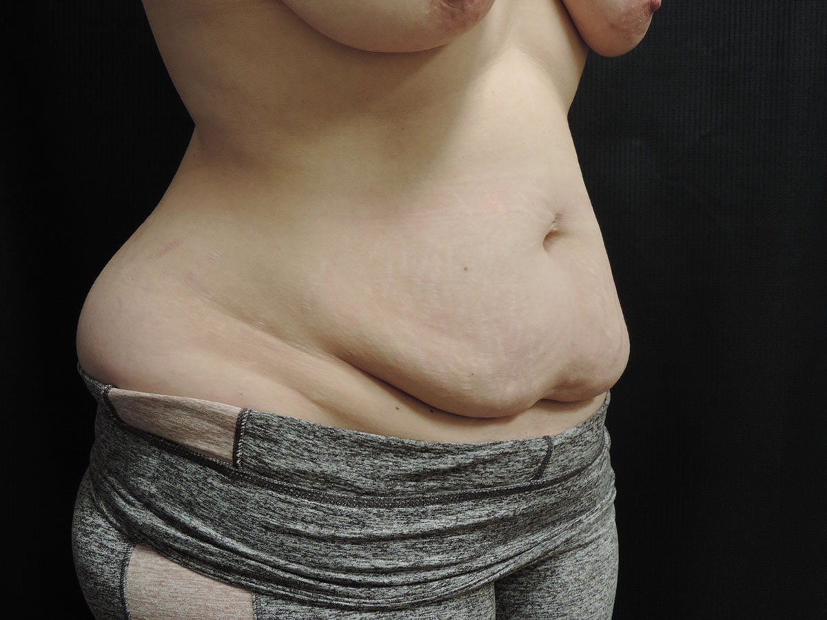 Tummy Tuck Akron Before & After | Patient 07 Photo 0 Thumb