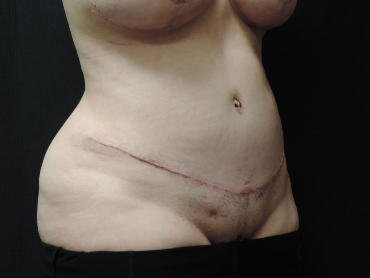 Tummy Tuck Akron Before & After | Patient 07 Photo 1