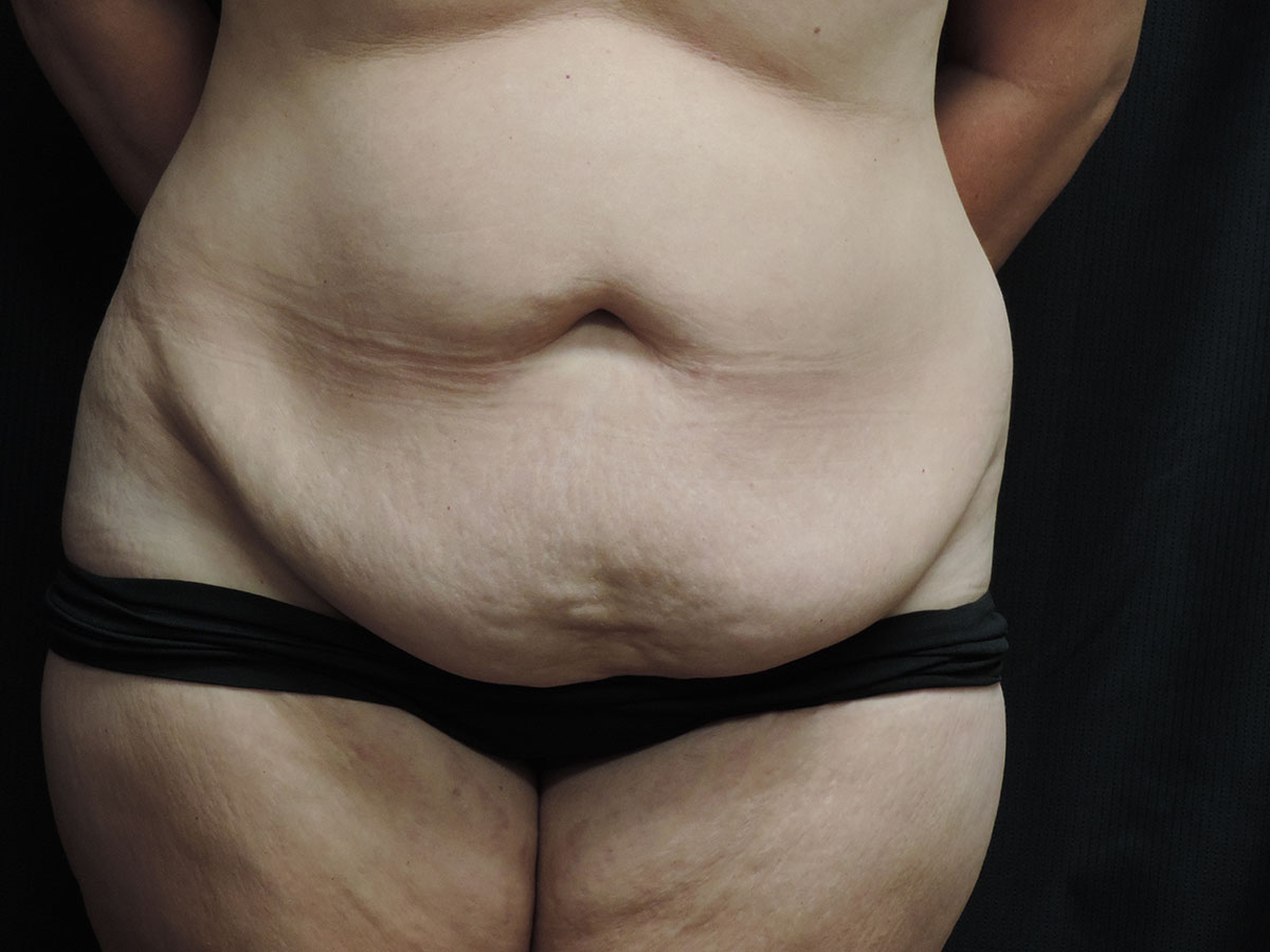 Tummy Tuck Akron Before & After | Patient 09 Photo 0