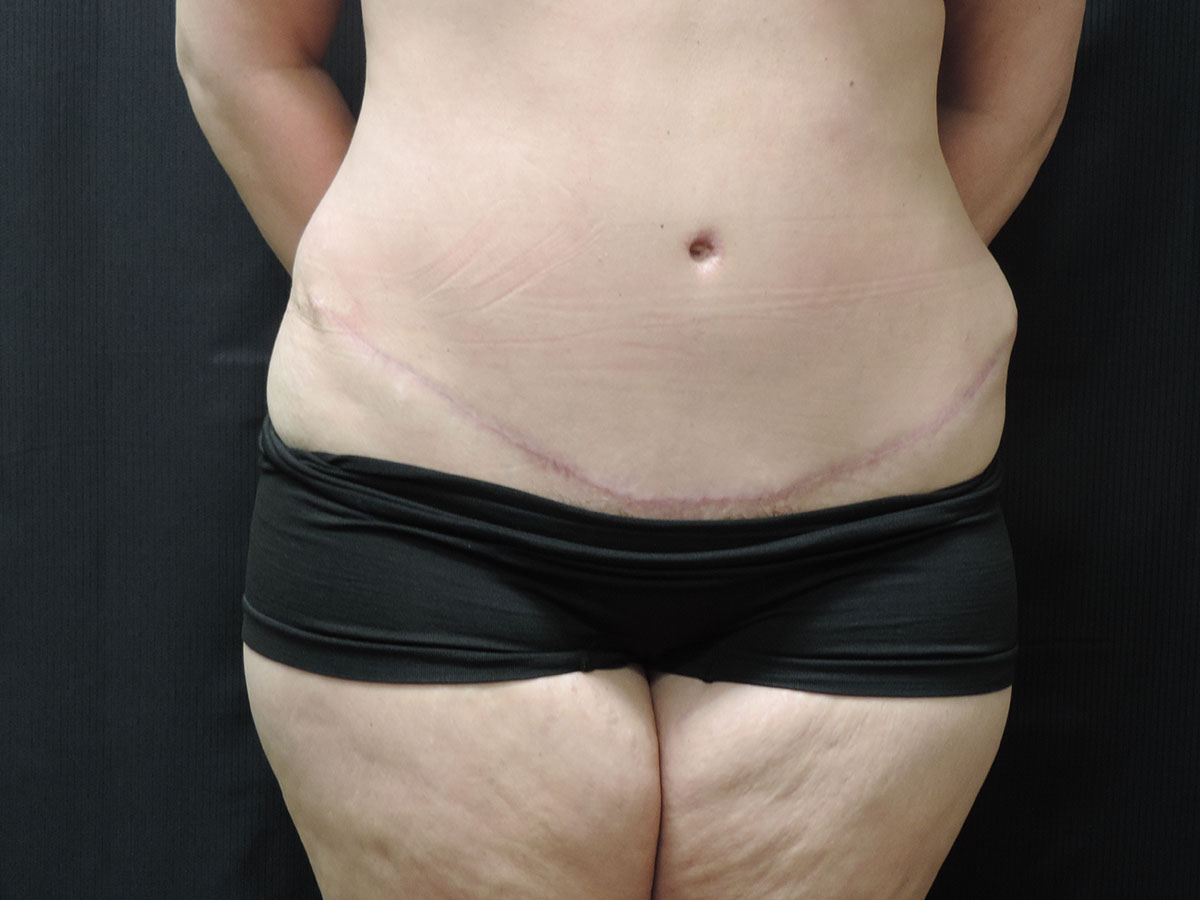 Tummy Tuck Akron Before & After | Patient 09 Photo 1
