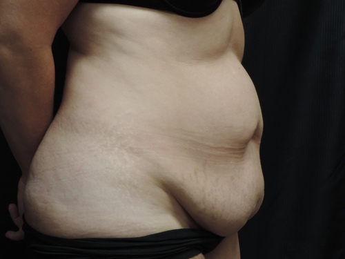 Tummy Tuck Akron Before & After | Patient 09 Photo 2