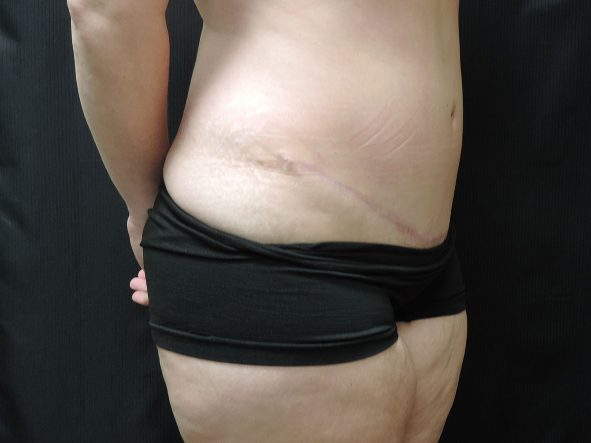 Tummy Tuck Akron Before & After | Patient 09 Photo 3 Thumb
