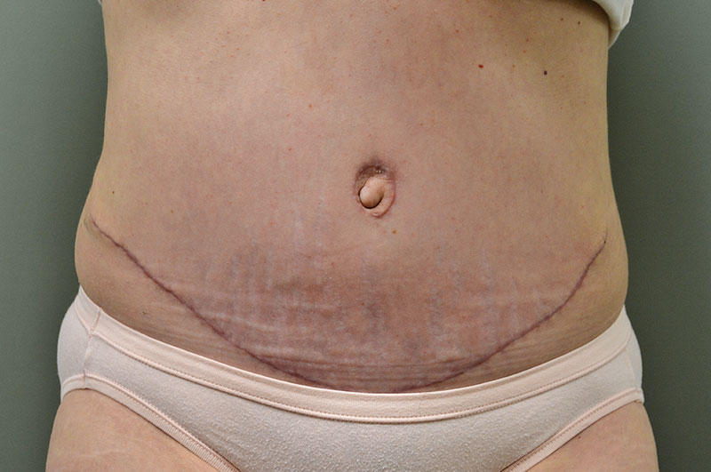 Tummy Tuck Akron Before & After | Patient 11 Photo 1
