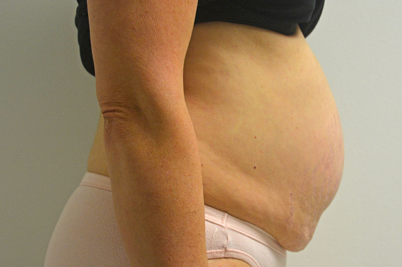 Tummy Tuck Akron Before & After | Patient 11 Photo 2