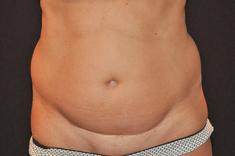 Tummy Tuck Akron Before & After | Patient 12 Photo 0 Thumb