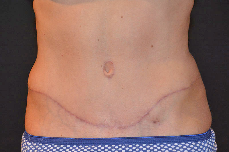 Tummy Tuck Akron Before & After | Patient 12 Photo 1