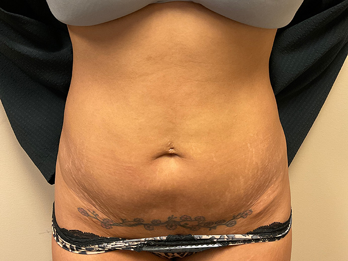 Tummy Tuck Akron Before & After | Patient 15 Photo 0