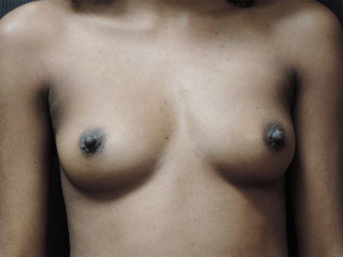 Breast Augmentation Akron Before & After | Patient 01 Photo 0