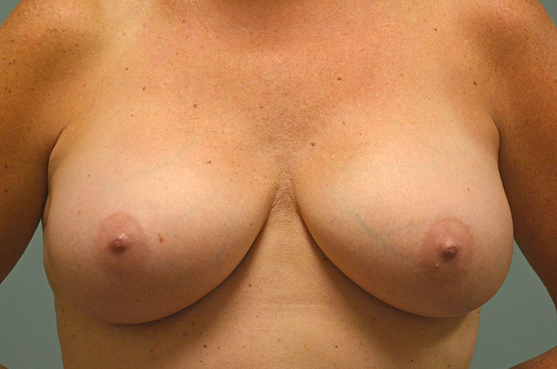 Breast Augmentation Akron Before & After | Patient 04 Photo 1