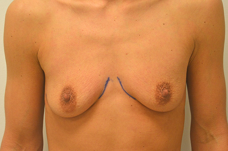 Breast Augmentation Akron Before & After | Patient 06 Photo 0