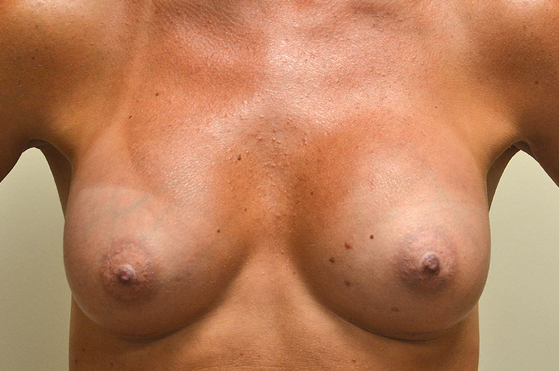 Breast Augmentation Akron Before & After | Patient 09 Photo 1 Thumb