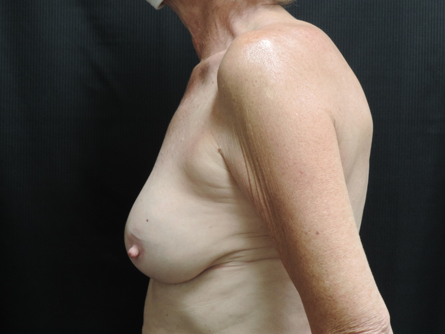 Breast Reconstruction Akron Before & After | Patient 03 Photo 9