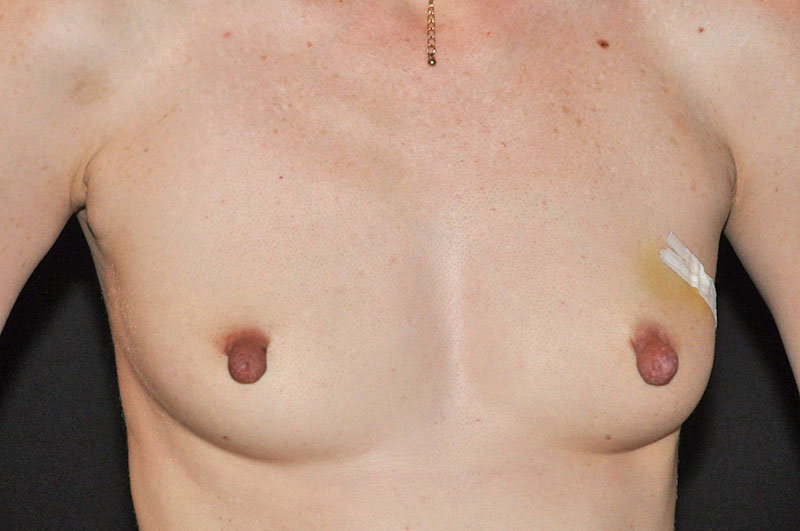 Breast Reconstruction Akron Before & After | Patient 07 Photo 0