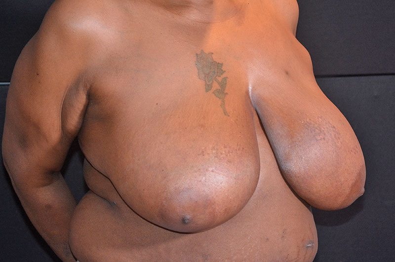Breast Reduction Akron Before & After | Patient 05 Photo 2