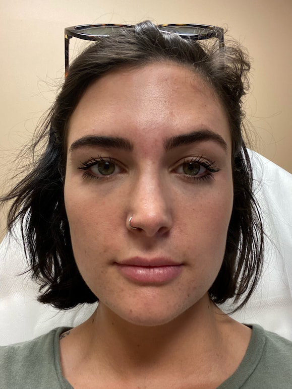 Fillers Akron Before & After | Patient 01 Photo 2