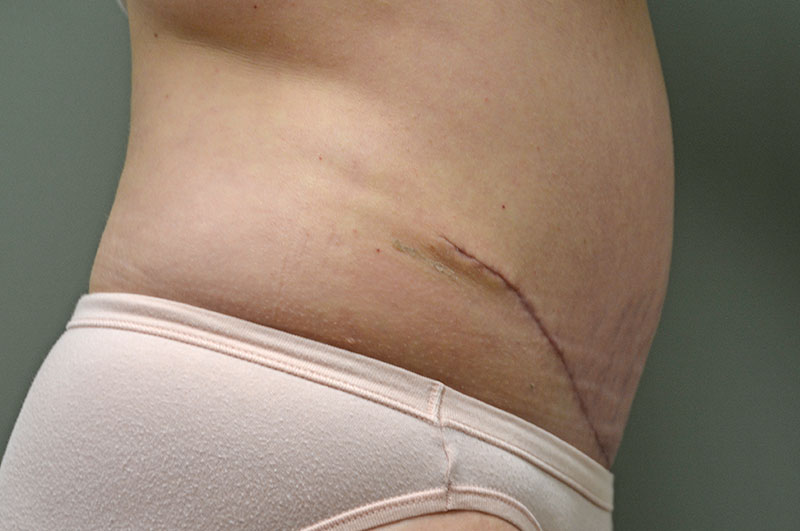 Tummy Tuck Scars Before & After, Patient 04